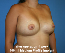 plastic-surgery-breast-augmentation